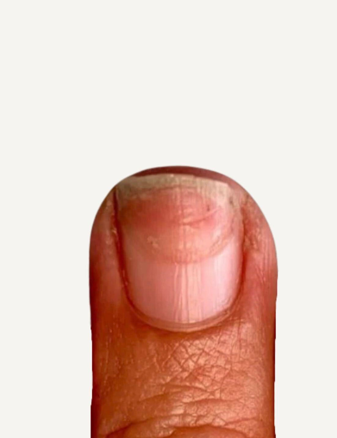 Rings of Fire on Nails: What Causes Them, Why They Happen and How to Prevent Them