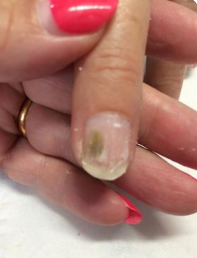 How to identify if you have mold on your nail