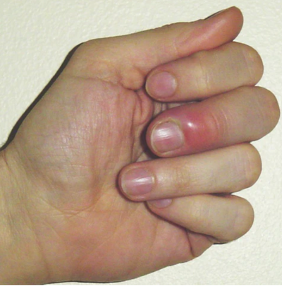 Identifying Common Nail Disorders